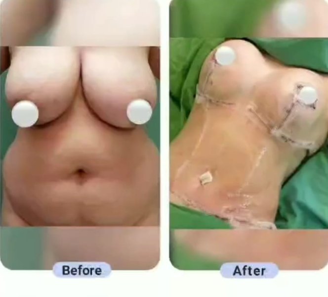 Tummy Tuck Surgery Before After