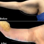 arm liposuction