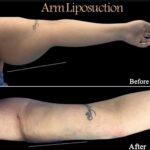 arm liposuction