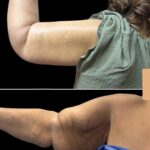 arm liposuction