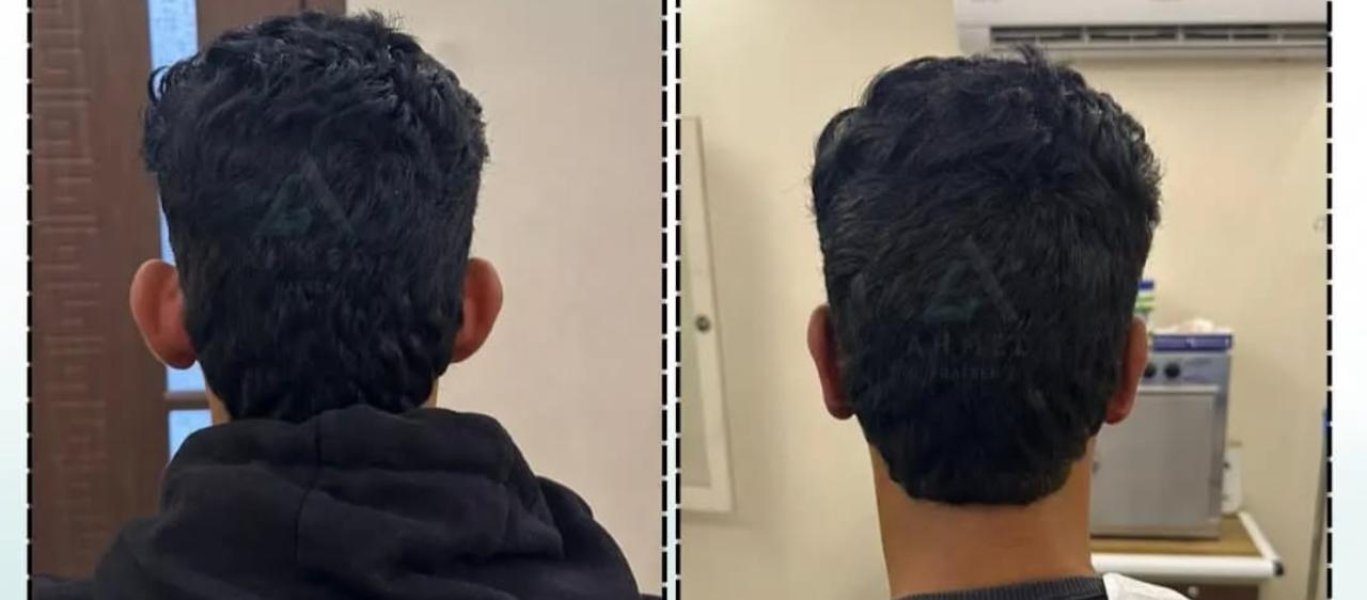 Back View Hair Transplanttheimageshowstwoside By Sidephotosofamansheadfrombehindshowcasinghishairthemanhasshortdarkhairandiswearingablackhoodieintheleftphotoandawhiteshirtintherightphotothebackgroundofbothphotosappearsto