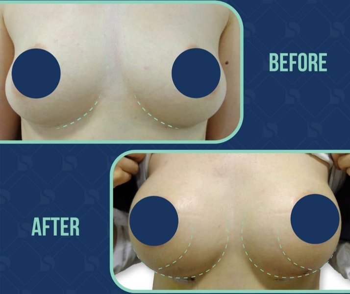 Breast Augmentation Before After