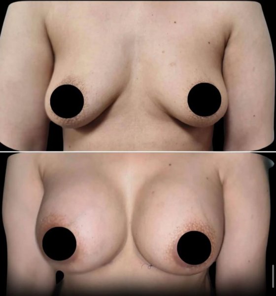 Breast Augmentation Results