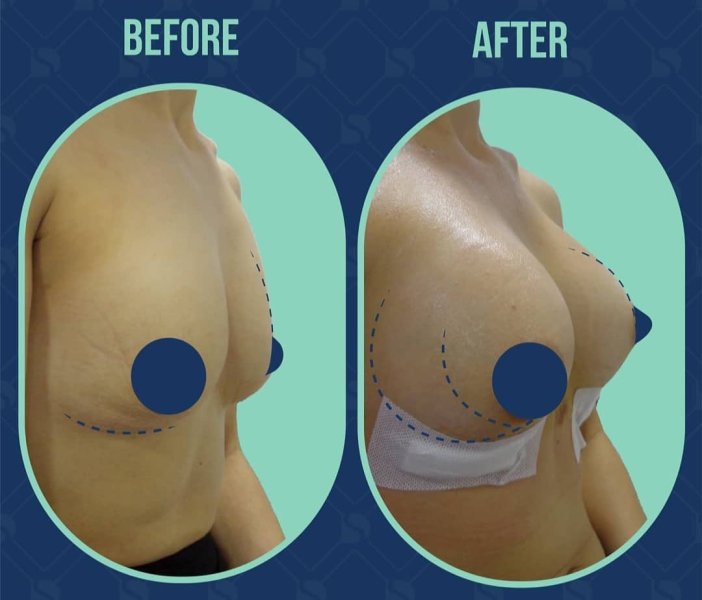Breast Augmentation Results