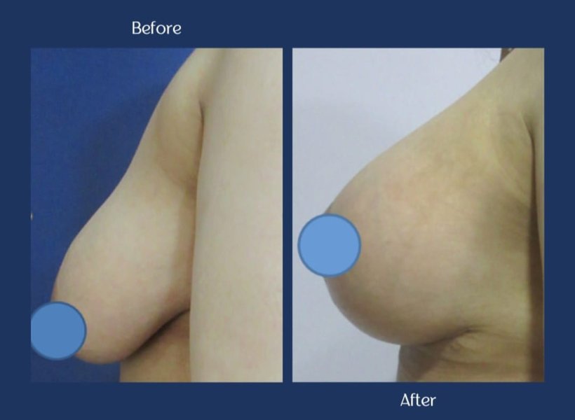 Breast Augmentation Results