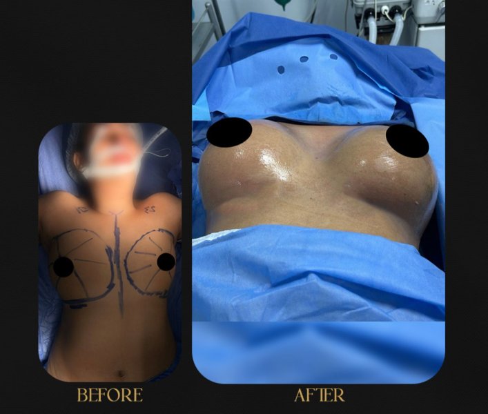 Breast Augmentation Surgery