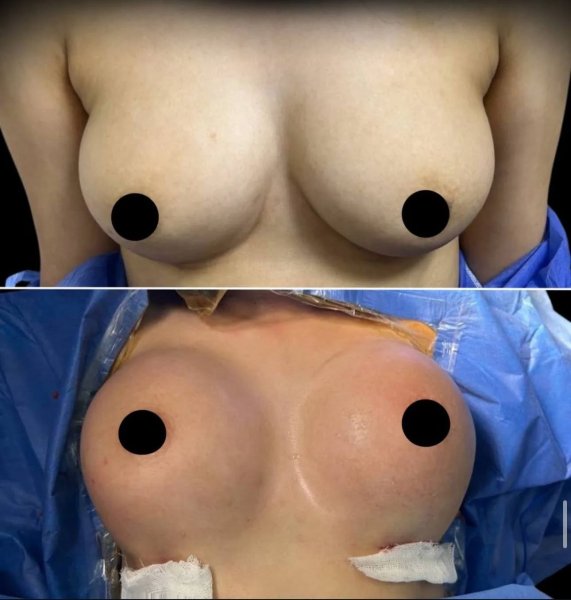Breast Augmentation Surgery Before After