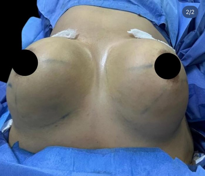 Breast Augmentation Surgery Blue Drapes