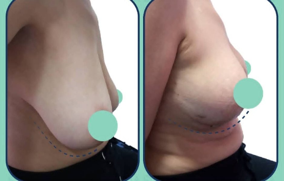 Breast Lift Comparison Before After