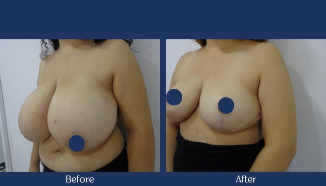 Breast Reduction Surgery Before After