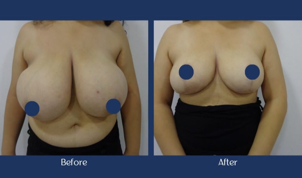 Breast Reduction Surgery Before After