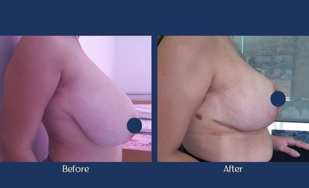 Breast Reduction Surgery Results