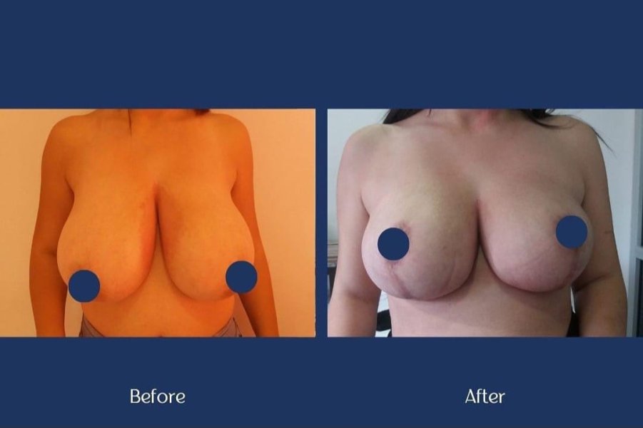 Breast Reduction Surgery Results