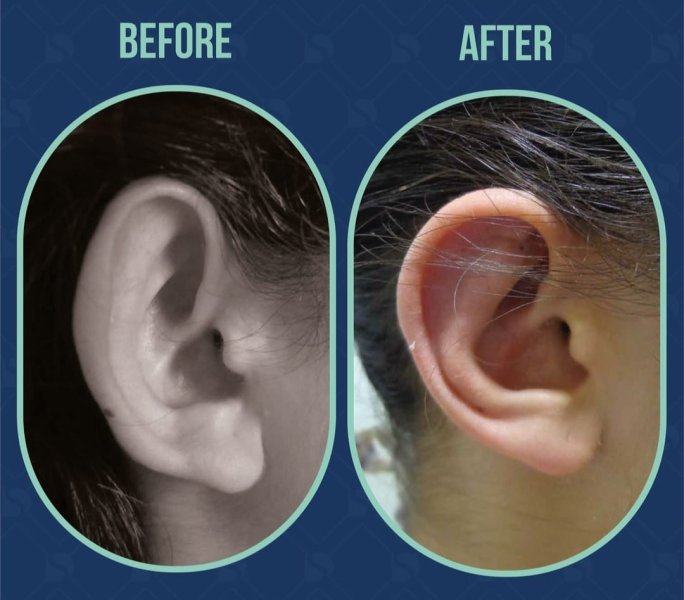 Ear Piercing Transformationtheimageshowsabefore And Aftercomparisonofapersonsearspecificallyfocusingontheearsappearanceafteranearpiercingorotoplastyproceduretheimagefeaturestwooval Shapedphotosofanearonelabeledbeforeandtheotheraf