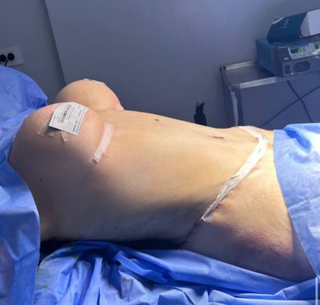 Post Op Abdominoplasty Scars