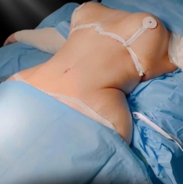 Post Op Buttock Surgery Blue Drapes