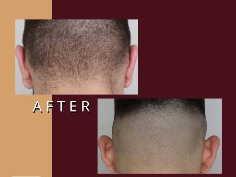 Scalp Micropigmentation Before After