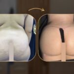 360 Liposuction Before&After