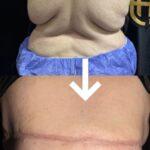 360 Liposuction