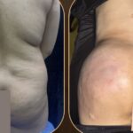 360 Liposuction