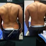360 Liposuction Before&After