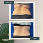 360 Liposuction Before&After