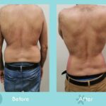 360 Liposuction Before&After