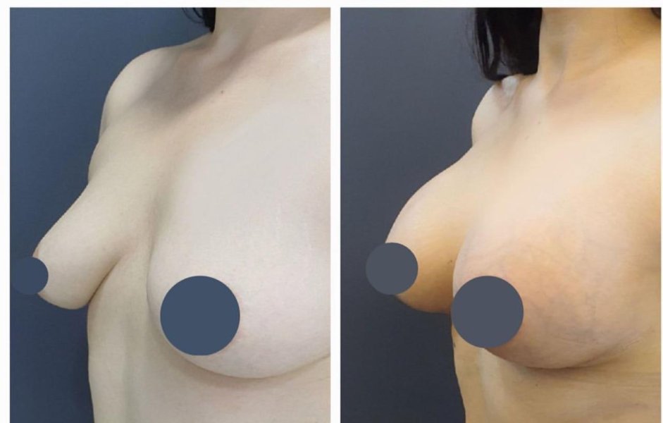 Breast Augmentation Before After