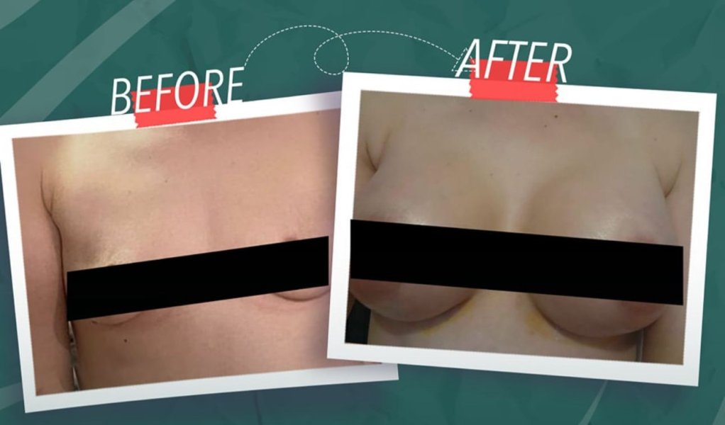 Breast Augmentation Results