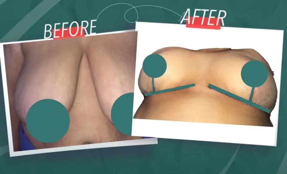 Breast Augmentation Results