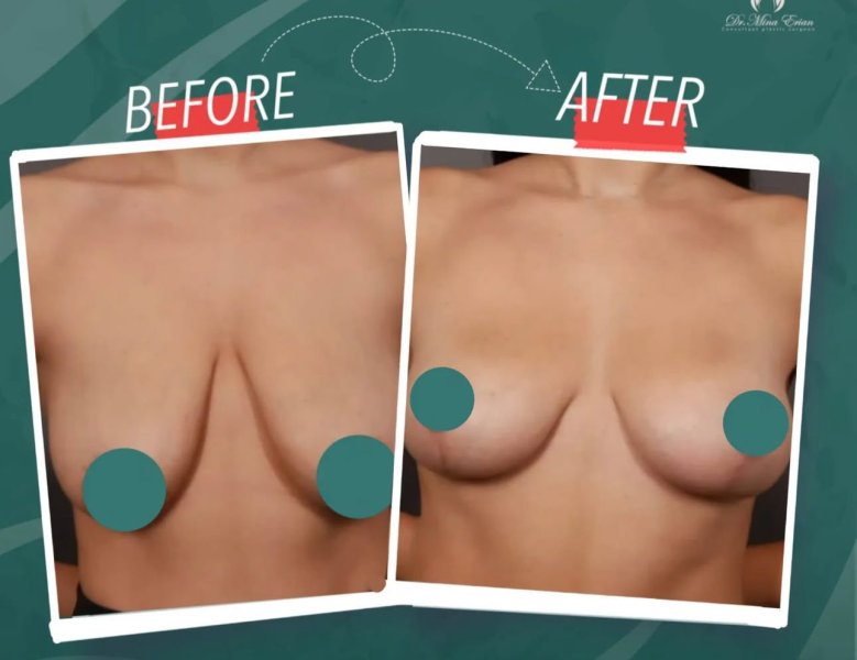 Breast Augmentation Results