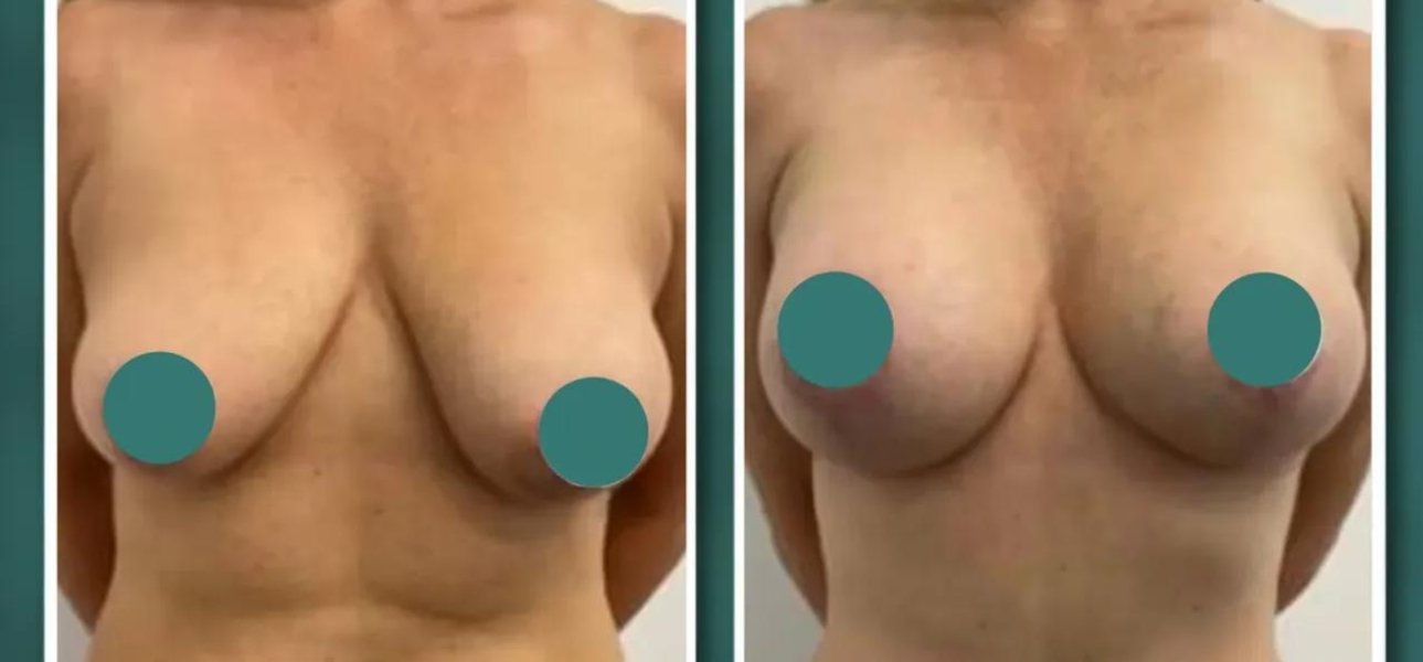 Breast Augmentation Results