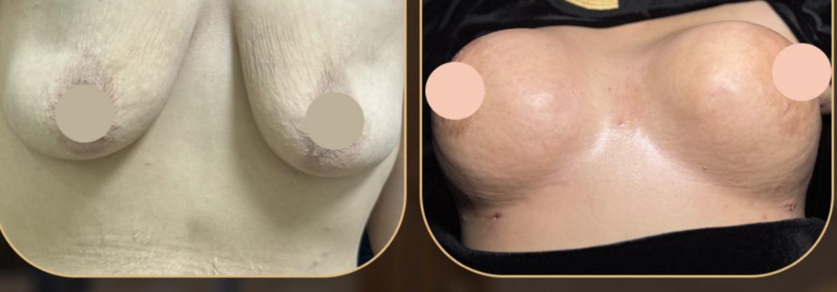 Breast Augmentation Results