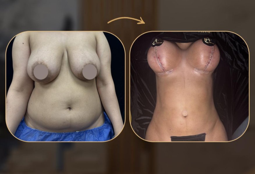 Breast Augmentation Surgery Before After