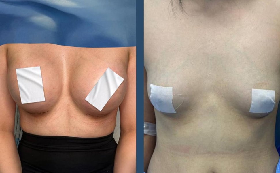 Breast Reduction Surgery Comparison