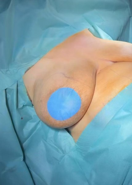Breast Surgery Blue Drapes Sticker