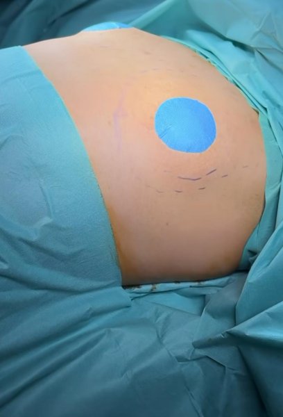 Buttock Surgery Prep