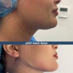 Double Chin Surgery Before After