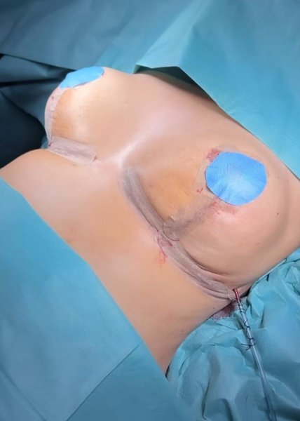 Post Mastectomy Breast Surgery Scars