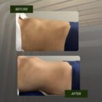 Tummy Sculpting Before After