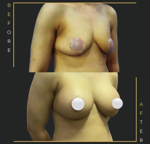 Breast Augmentation Results