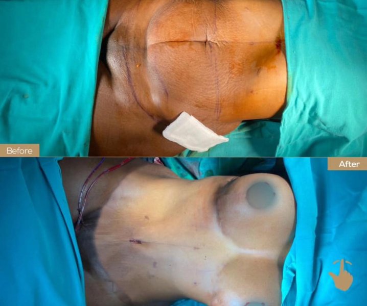 Breast Reconstruction Surgery Scars