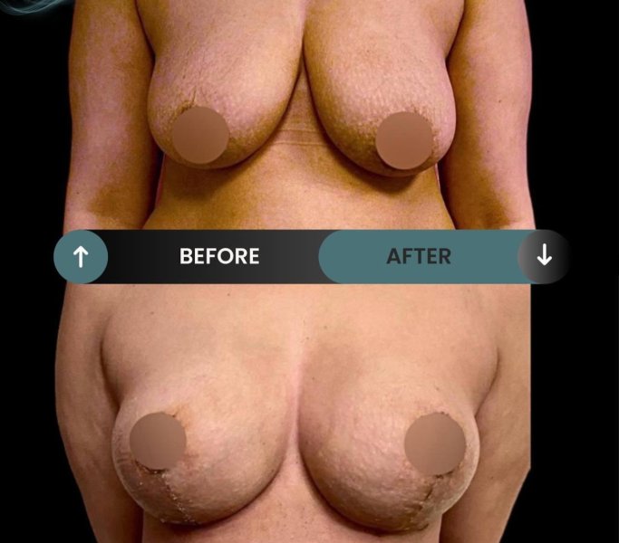 Breast Reduction Surgery Results