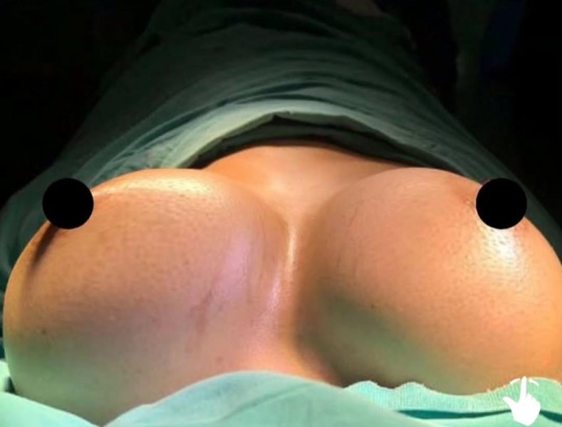 Gluteal Surgery Scars Revealed