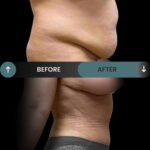 Tummy Tuck Transformation