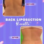 360-liposuction