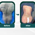 360 Liposuction Before&After