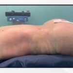 360 Liposuction Before&After