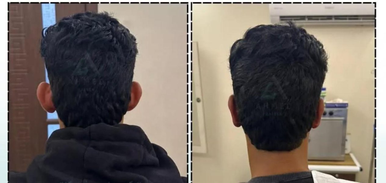 Before After Hair Transplanttheimageshowsapersonsheadfrombehindwithtwodifferentviewsthepersonhasshortdarkhairandiswearingablackhoodieontheleftandagrayshirtontherightthebackgroundappearstobeanindoorsettingpossiblyamedicalorprofessional