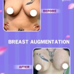 breast reduction
